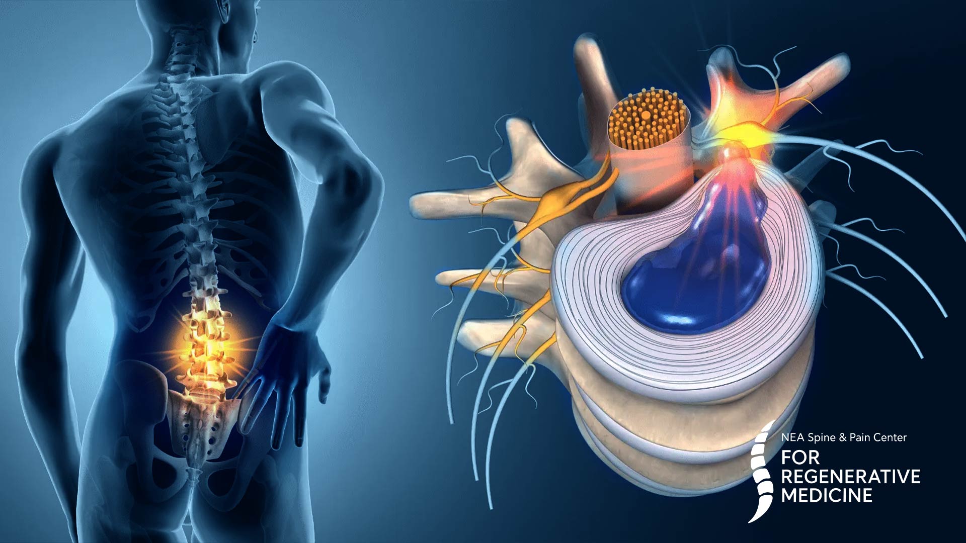 Percutaneous-Discectomy -And-Annuloplasty 